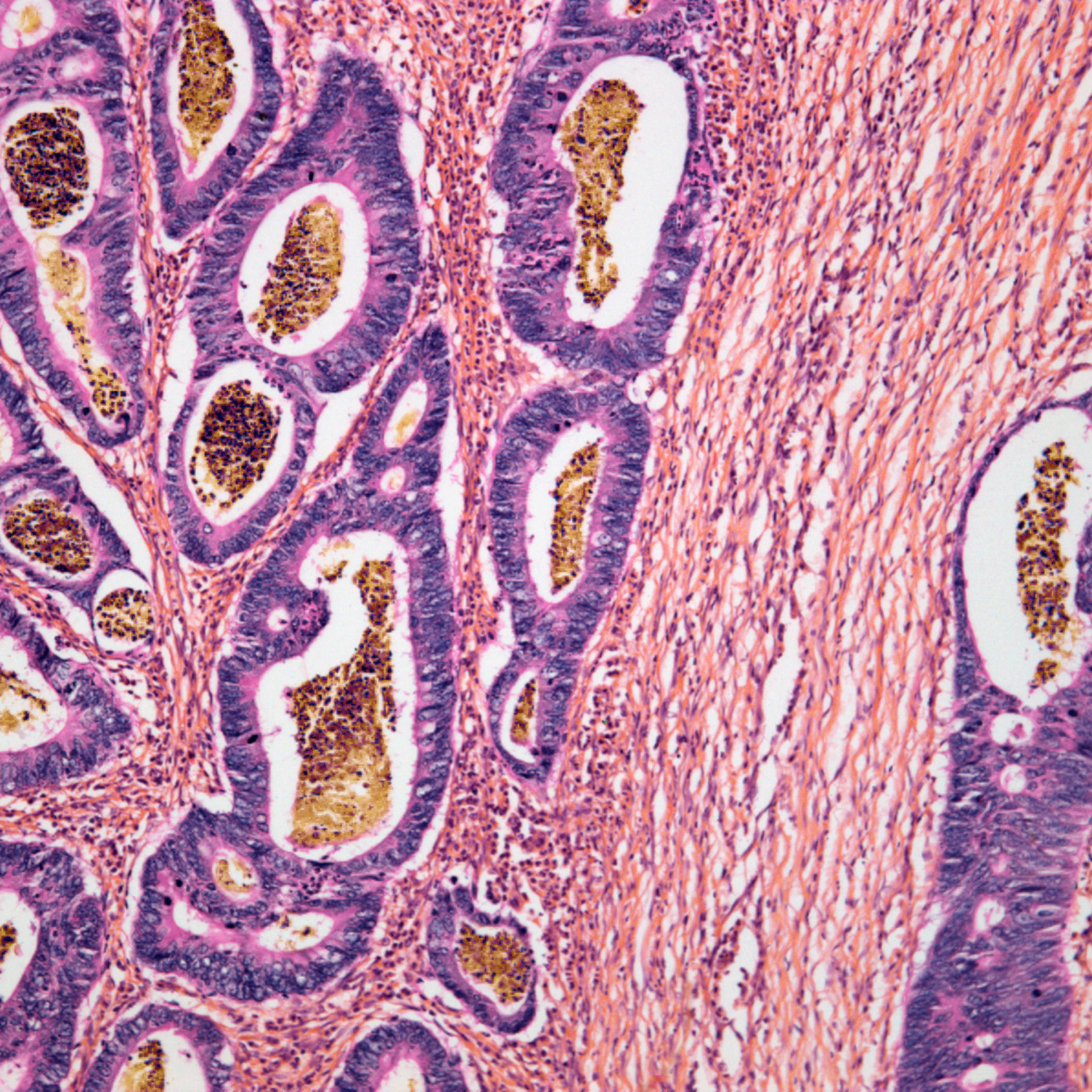 Colon cancer, light micrograph