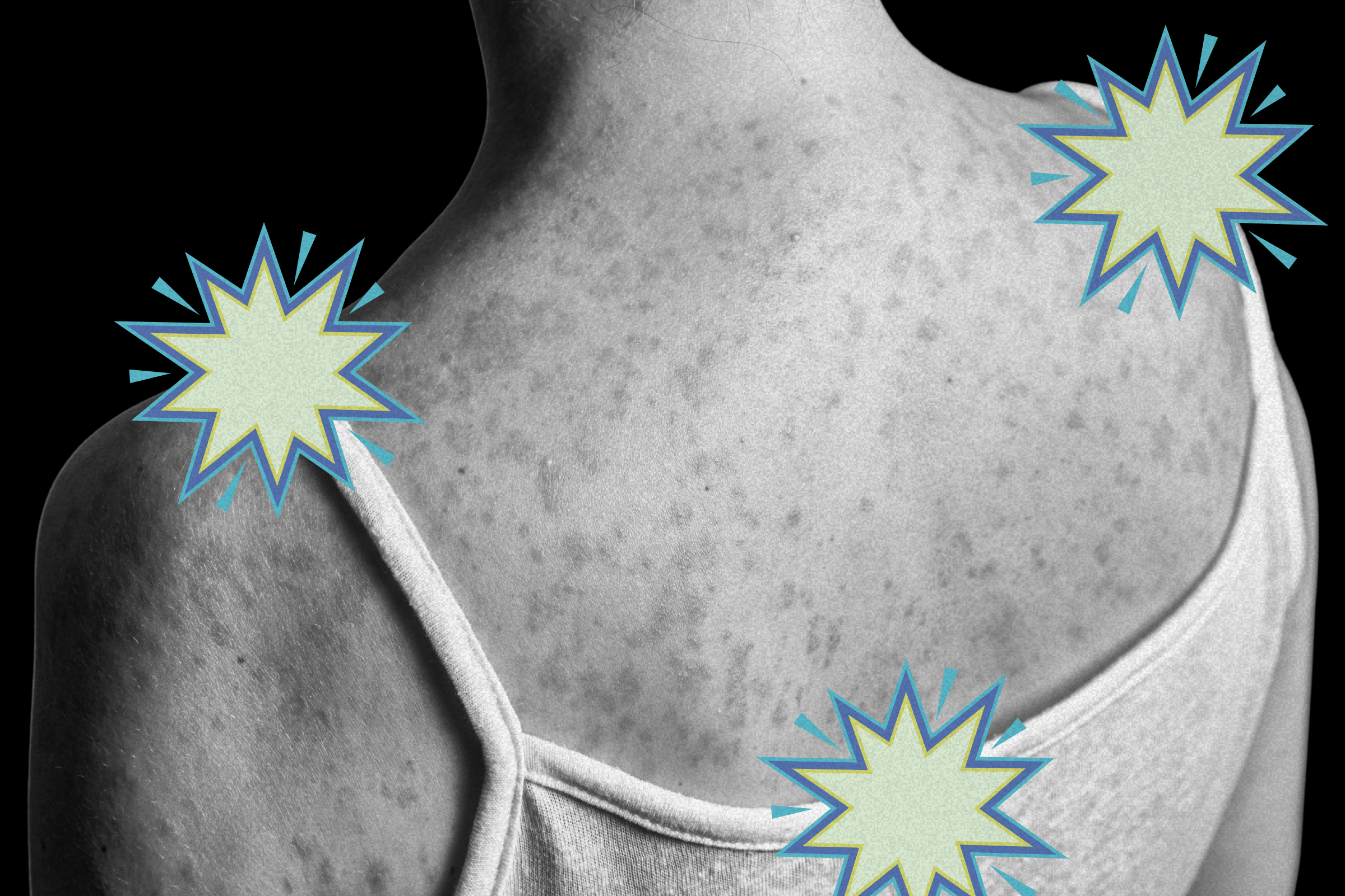 The Long-Term Measles Complication Most People Dont Know About