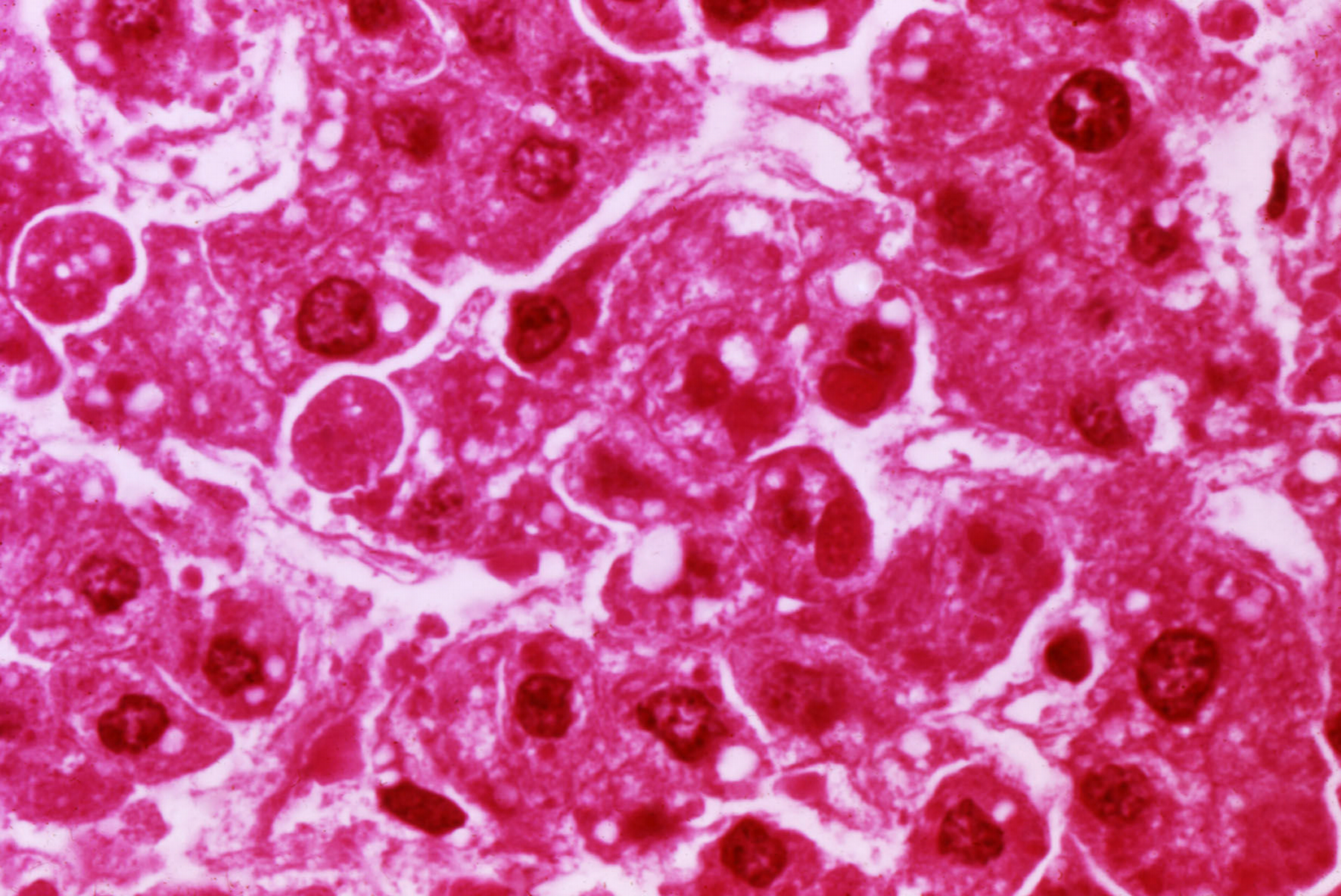 Ebola Virus