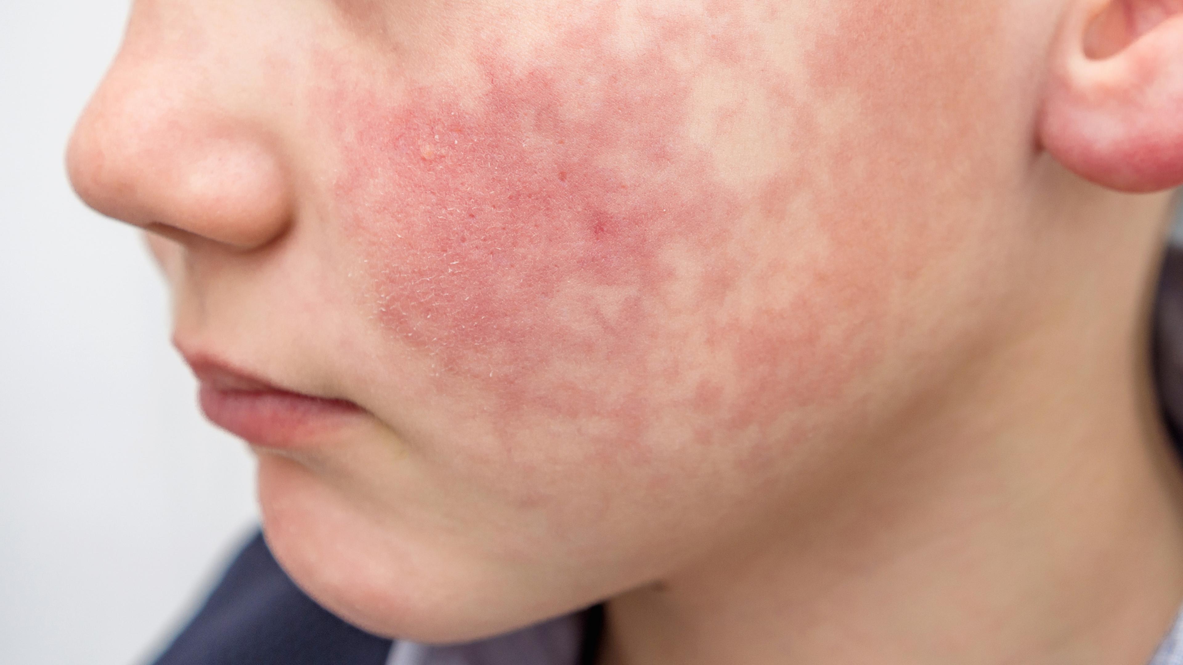 Parvovirus Hand Rash What to Know About Parvovirus B19