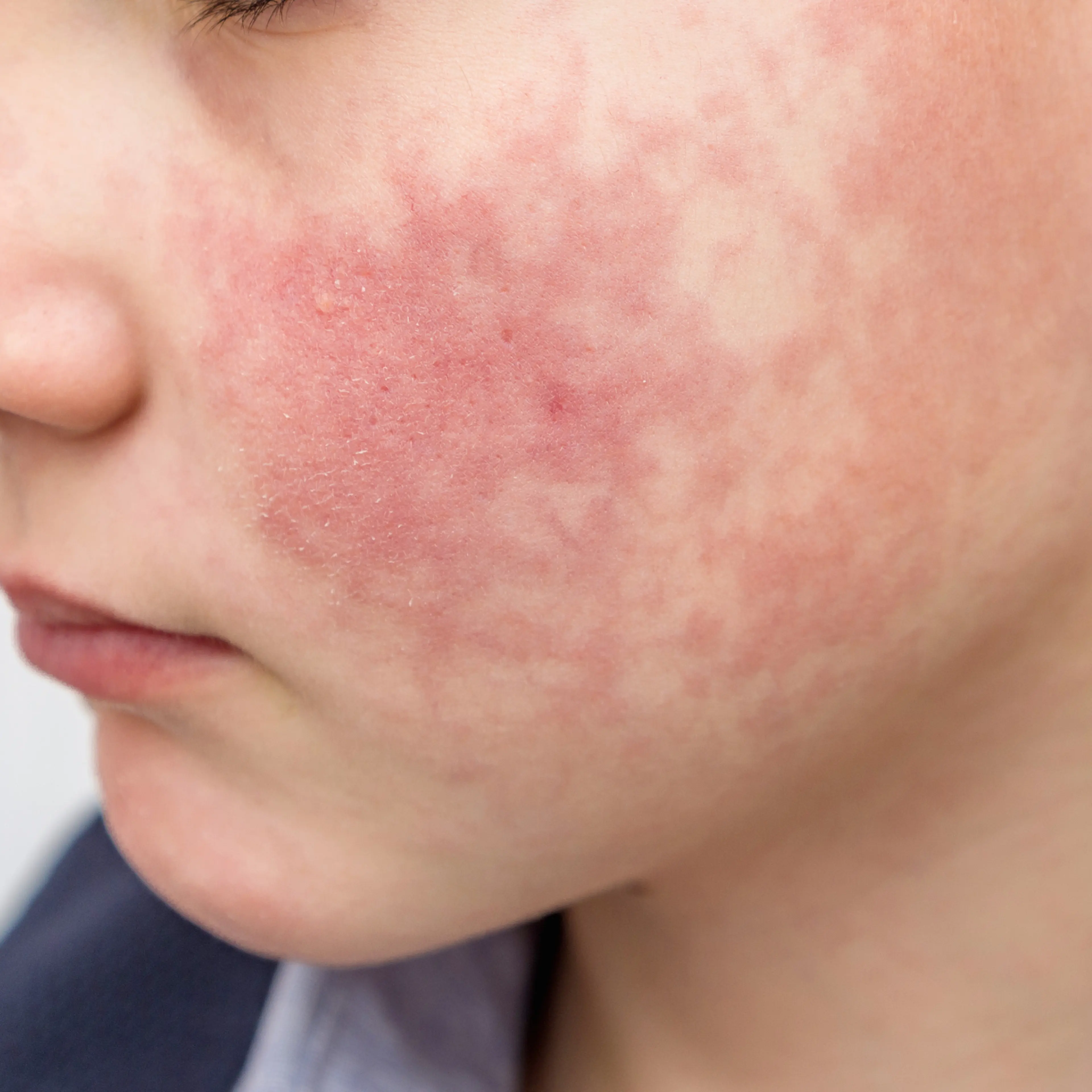 A young boy with slapped-cheek rash.