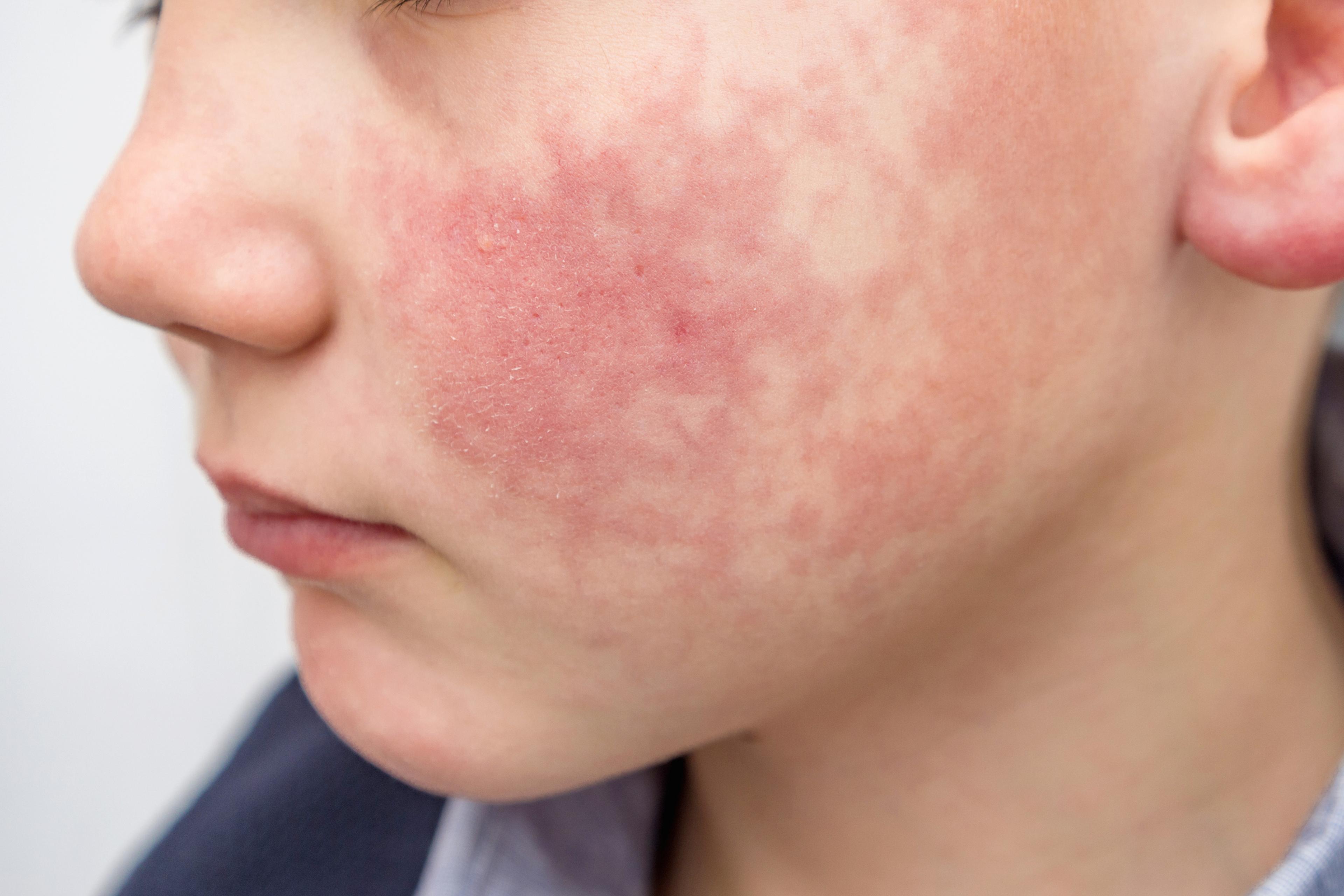 Parvirus Facial Rash What to Know About Parvovirus B19