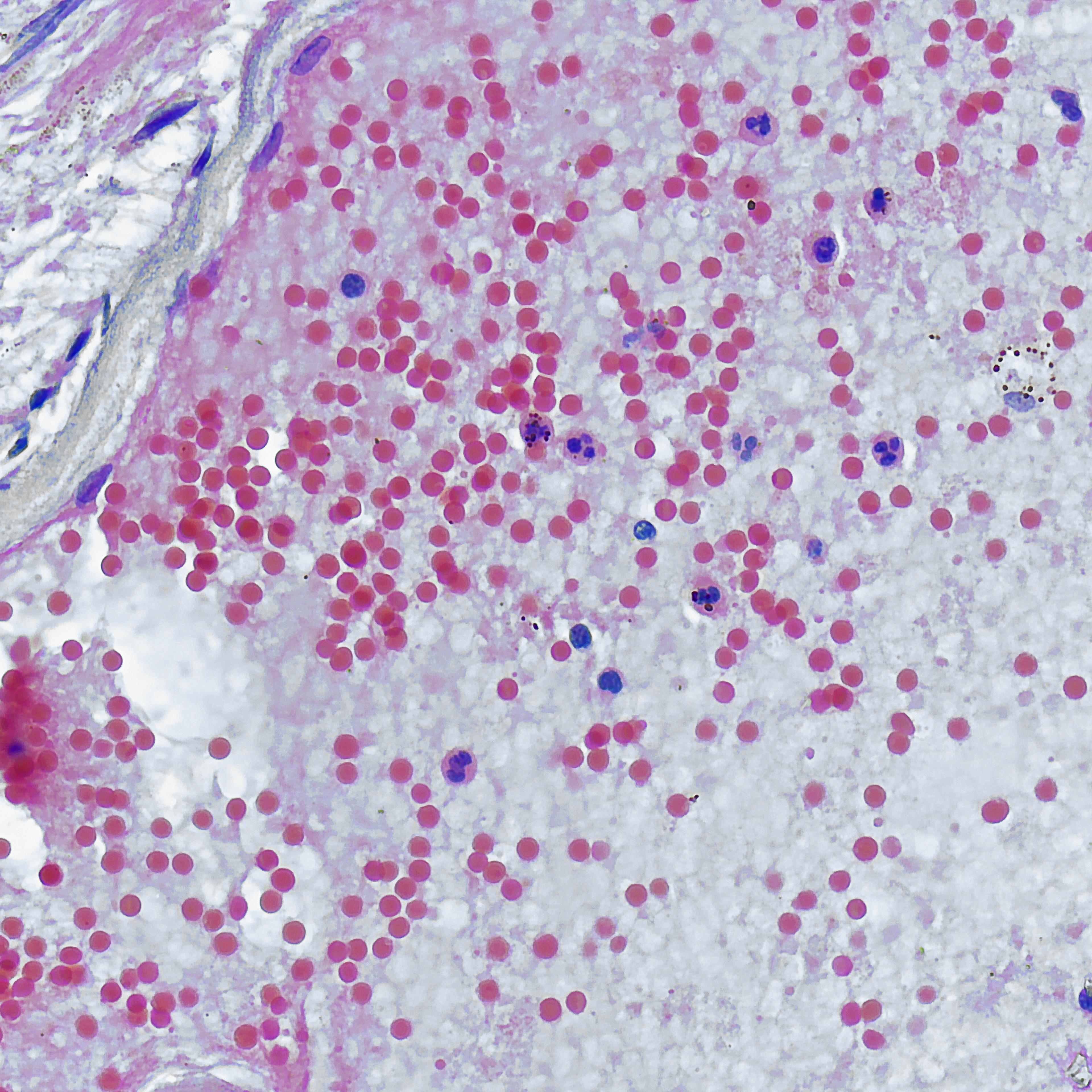 monkeypox-virus