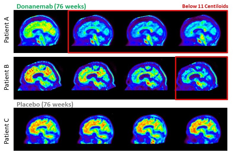 Brain scans show clearance of amyloid plaques, shown in red, in two patients, A and B, who received donanemab, compared to higher levels of amyloid in a patient who received placebo (bottom) in Eli Lilly's trial. 