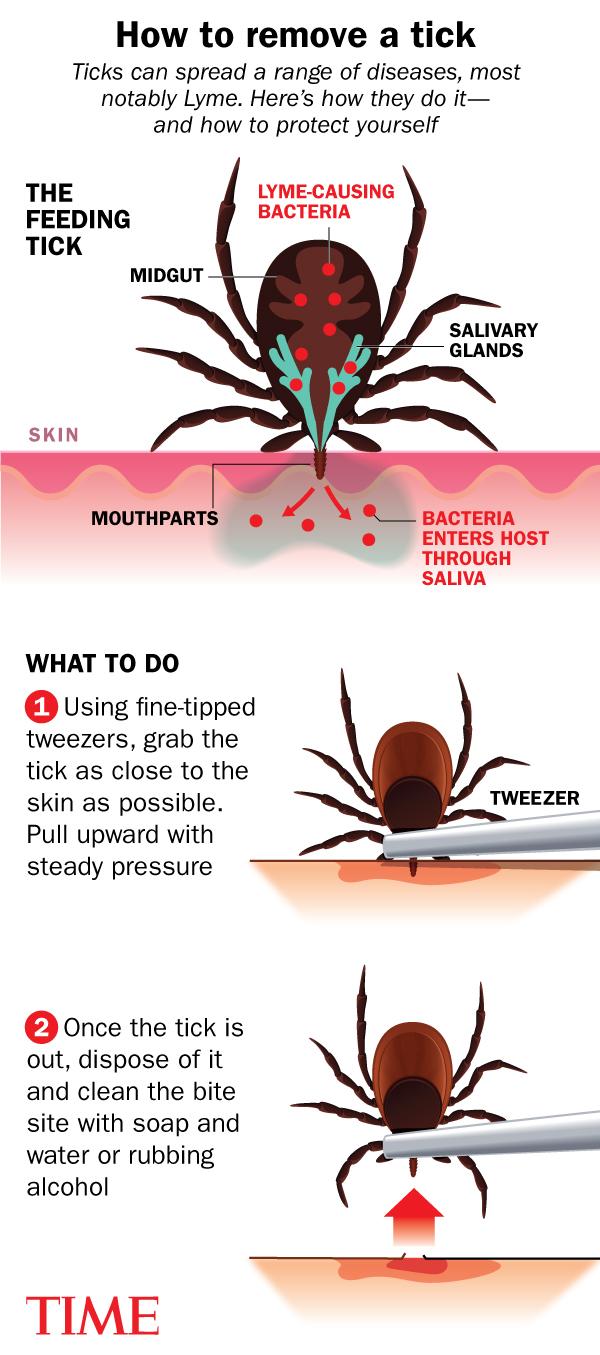 The Best and Worst Way to Remove a Tick