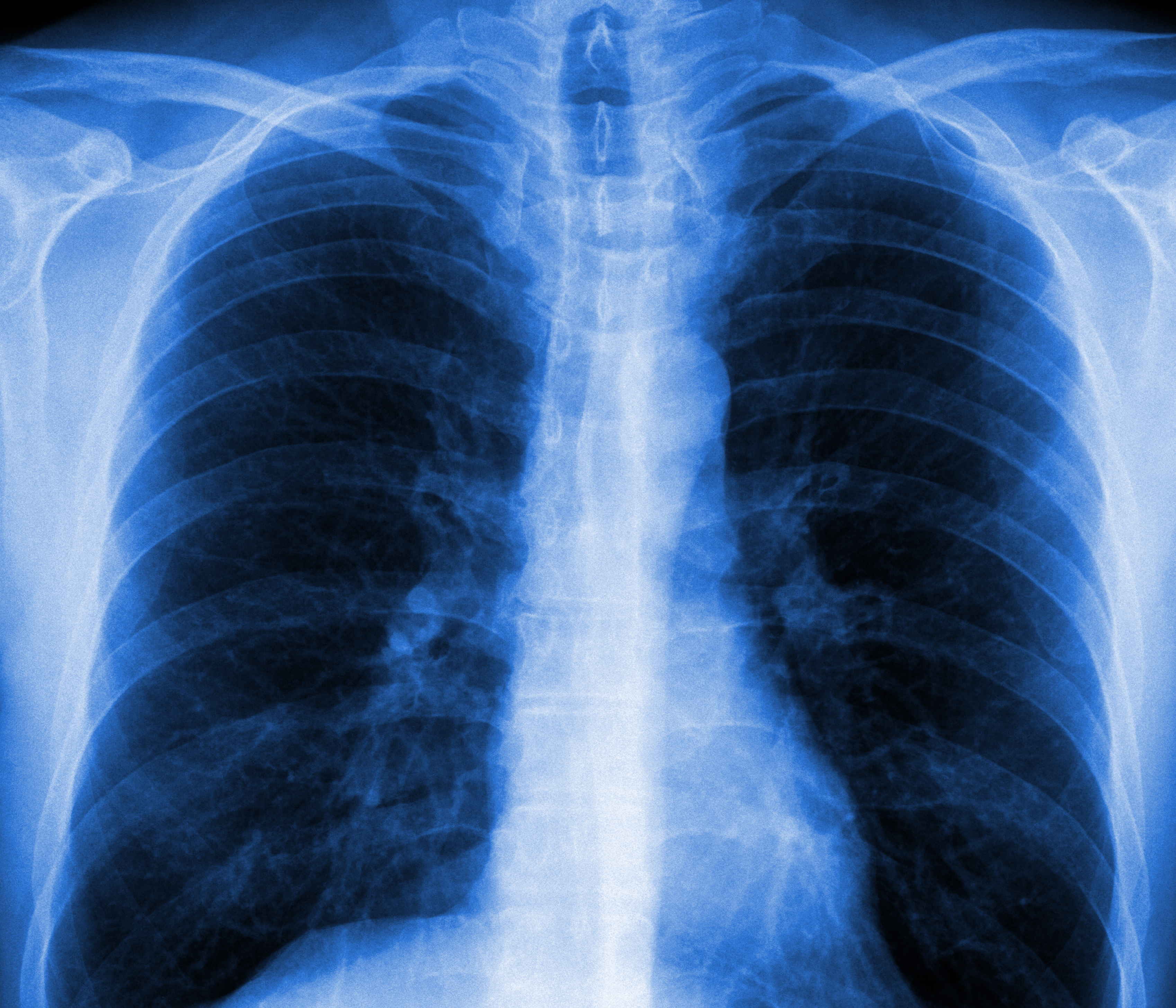 lung xray