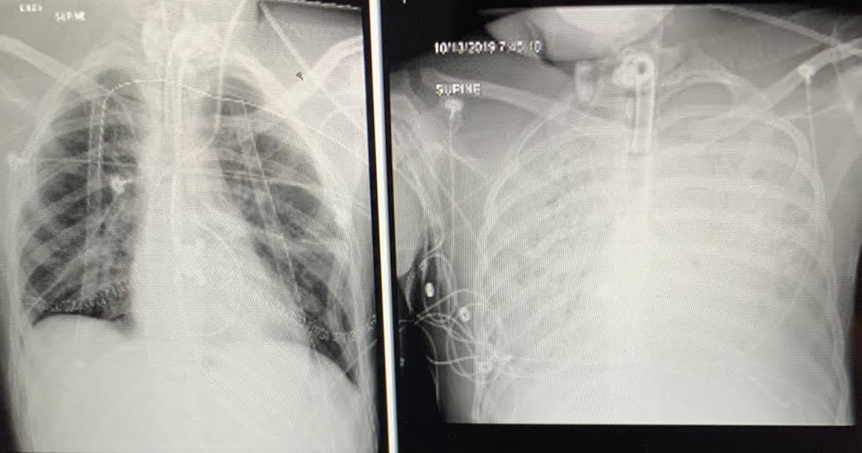 Teen Who Needed a Double Lung Transplant After Vaping Speaks Teen Who Needed a Double Lung Transplant After Vaping Speaks