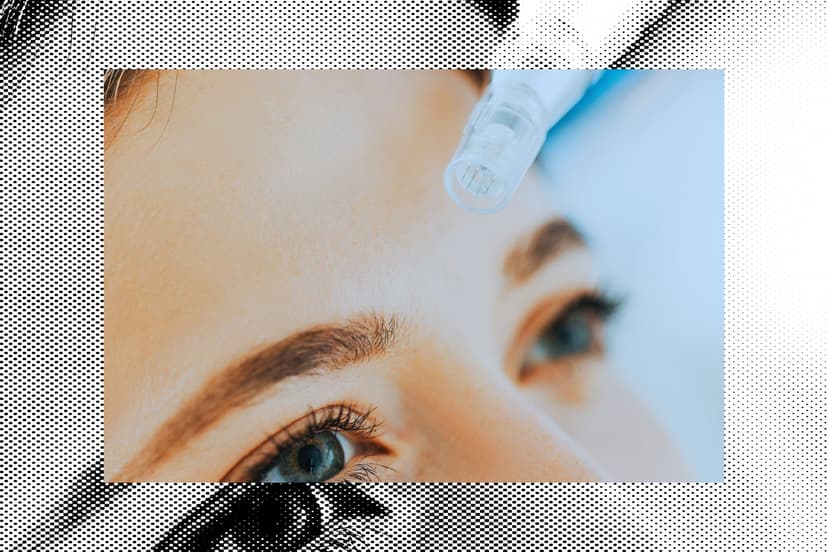 Does Microneedling Work—And Is It Safe?