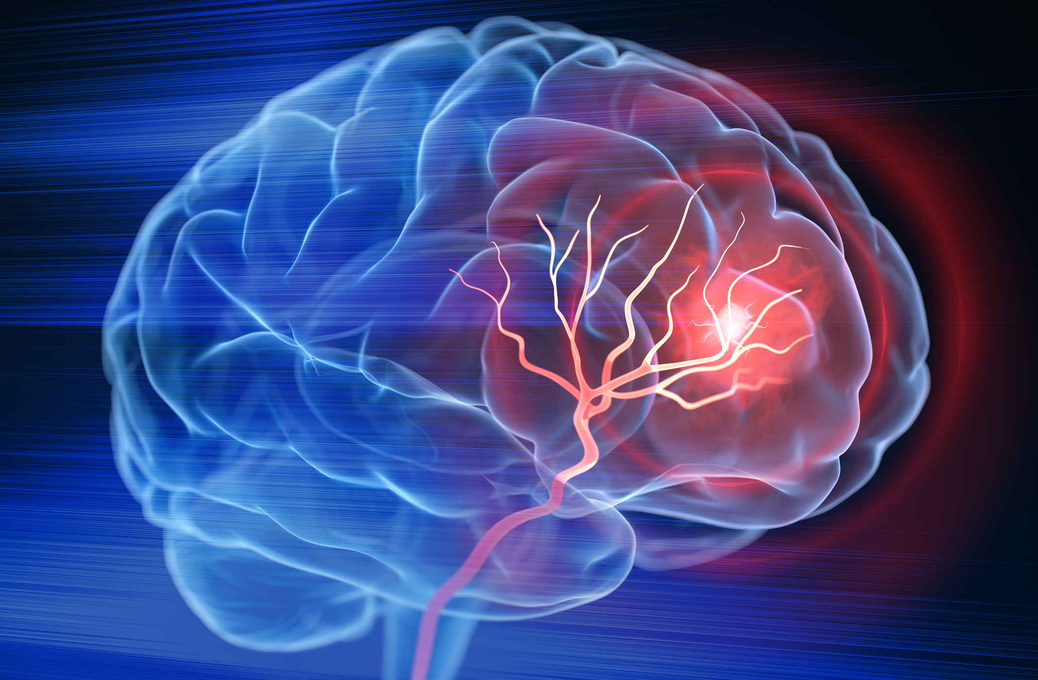Brain stroke